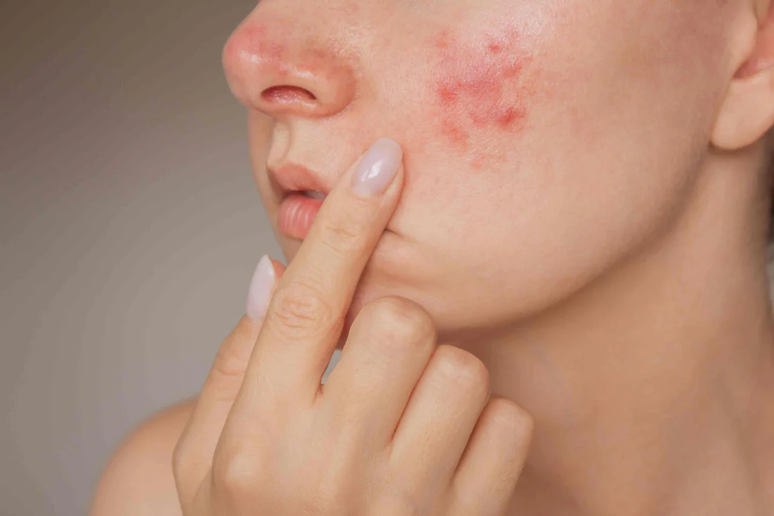Azelaic Acid for Sensitive Skin: A Multi-Target Approach to Acne and Redness
